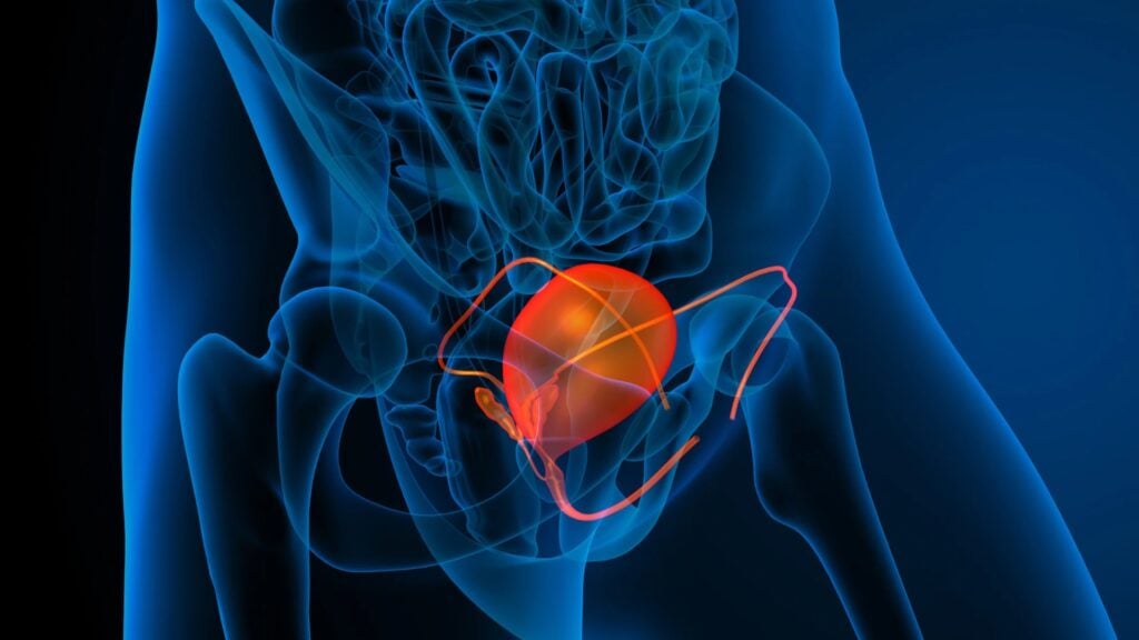 El riesgo de cáncer de vejiga urinaria es mayor en hombres, advierte el Centro Comprensivo de Cáncer de Puerto Rico