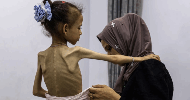 ©OMS Una niña pequeña con desnutrición grave recibe ayuda para vestirse.