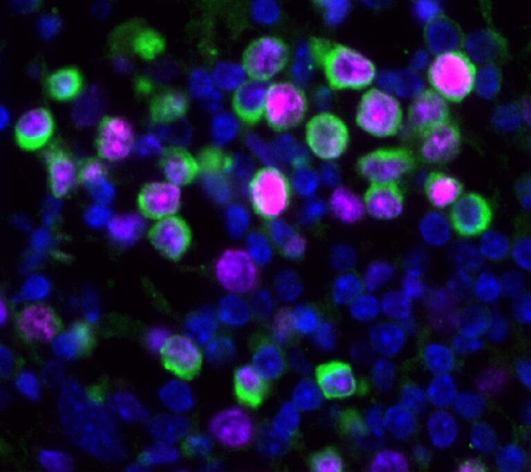 Infecciones respiratorias como la gripe o el COVID-19 podrían reactivar células cancerosas latentes, según estudio
