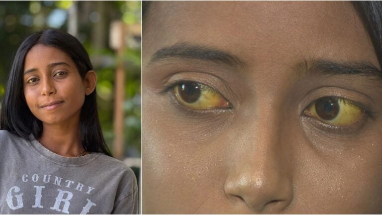 Adolescente con atresia biliar clama por un trasplante de hígado para sobrevivir